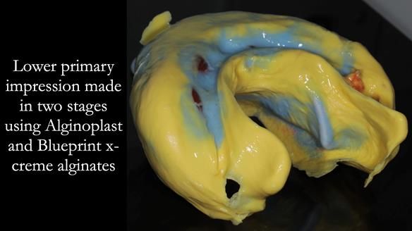 Finlay's Newsletter 59 Ultra hard partial dentures made for Gill