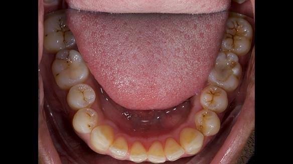 Upper metal base partial denture/occlusal stabilisation splint/obturator - full protocol