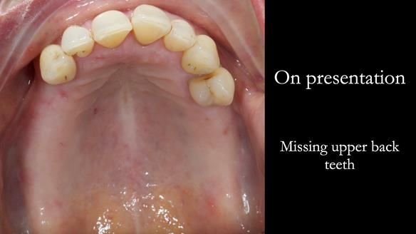 Newsletter 56 showing the making and fitting of a bilateral free end saddle upper removable partial denture (RPD) for patient with pemphigus