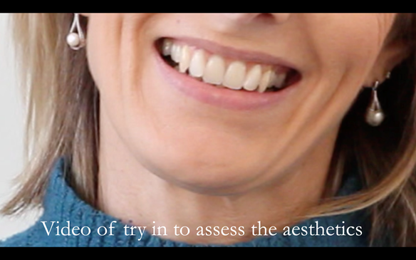 Figure 67 The patient assesses a video of the try in. This is a still shot of the video.