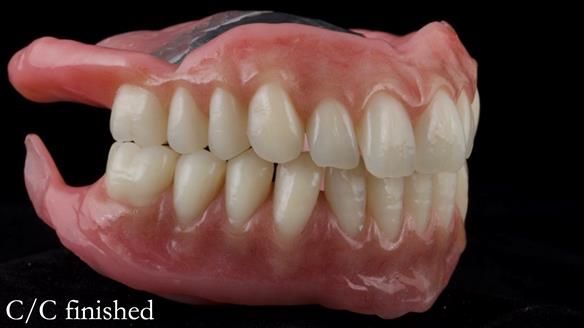 Managing poor implant positioning with complete dentures and Locator attachments - full protocol Newsletter 41
