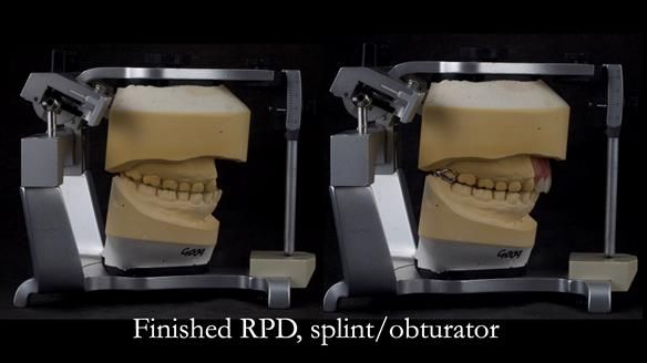 Upper metal base partial denture/occlusal stabilisation splint/obturator - full protocol