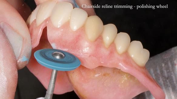 Newsletter 77: Jeremy’s case – immediate complete upper denture