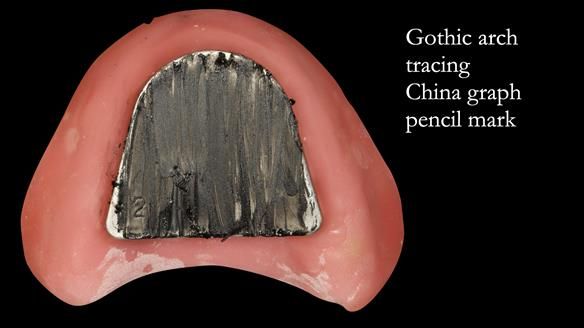 Sequence of use - patient is instructed to move lower jaw forward
