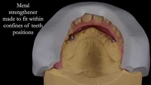 Newsletter 57 showcases the making and fitting process of implant-supported complete dentures for Alisdair