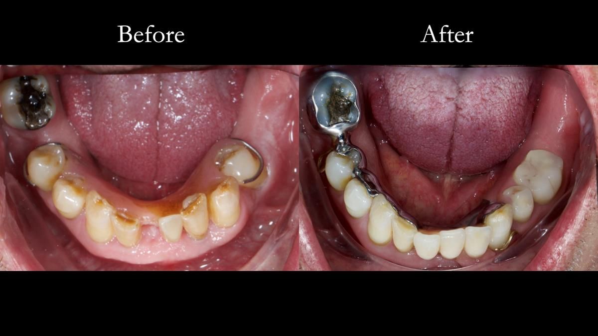 Newsletter 86 Peter the Architect — precision removable partial dentures case study