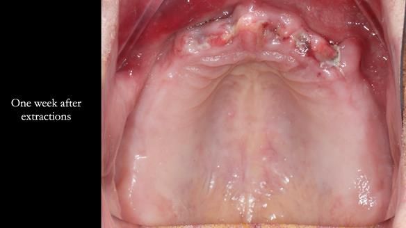 Finlay's Newsletter 62 provision of extractions and metal based complete dentures for Rafique