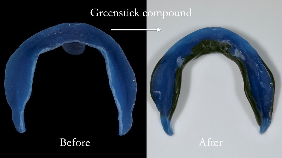 Fin’s Newsletter 88 — Complete dentures - full protocol… he rearranged his own teeth!