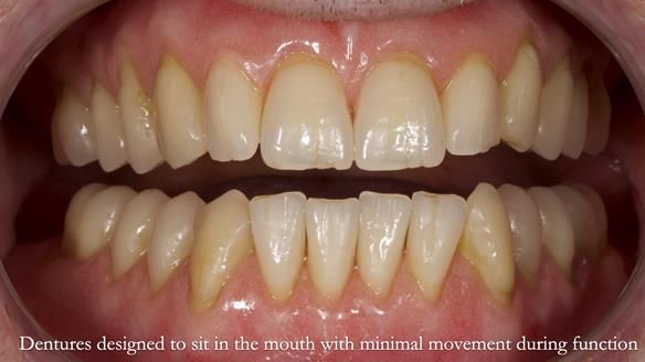 Newsletter 80 - Gordon’s dentures: the one case in 1,000 where my technique failed