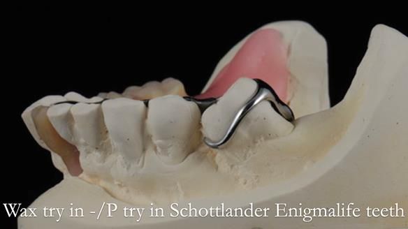 Newsletter 54 case presentation upper complete denture and lower Scandinavian designed hygienic partial denture for David
