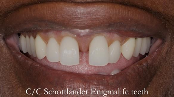 Newsletter 53 showing the making and fitting of ultra life-like dentures for Valena