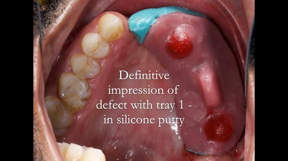 Upper metal base partial denture/occlusal stabilisation splint/obturator - full protocol