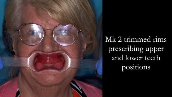 Replacing Madeline’s Complete denture FULL PROTOCOL