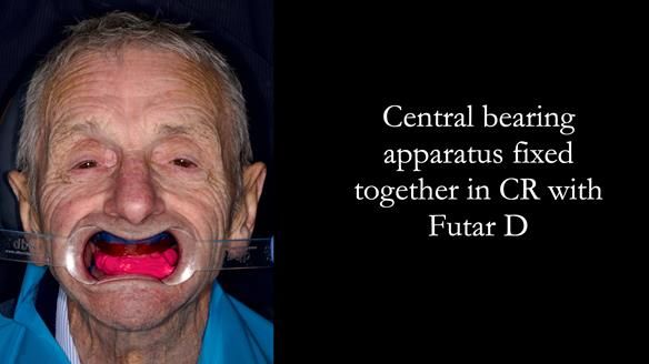 Newsletter 80 - Gordon’s dentures: the one case in 1,000 where my technique failed