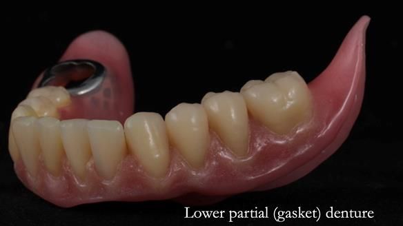 Newsletter 82 Mary - A complete upper and a one-tooth gasket denture