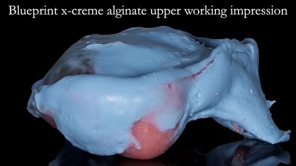 Newsletter 52 Managing Jo’s failing dentition with extractions and Mk 1/Mk 2 complete upper dentures and lower partial dentures FULL PROTOCOL