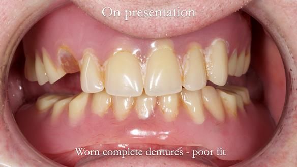 Newsletter 57 showcases the making and fitting process of implant-supported complete dentures for Alisdair