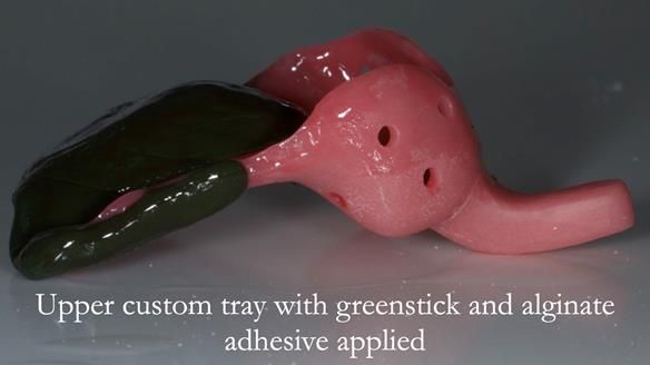 Finlay's Case Study Newsletter 40 - Immediate Mk 1 RPD to Definitive Mk 2 RPD - full protocol