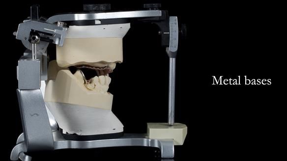 Newsletter 55 Provision of metal based partial dentures for Zephyrine with a repaired cleft lip and palate