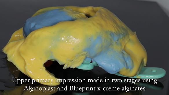 Finlay's Newsletter 59 Ultra hard partial dentures made for Gill