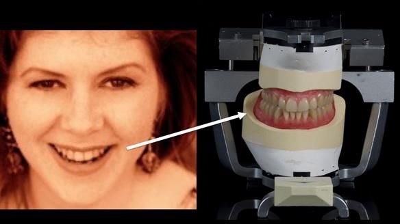 Newsletter 83: Sheila’s Complete Denture Success