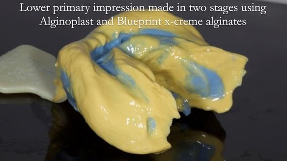 Newsletter 57 showcases the making and fitting process of implant-supported complete dentures for Alisdair