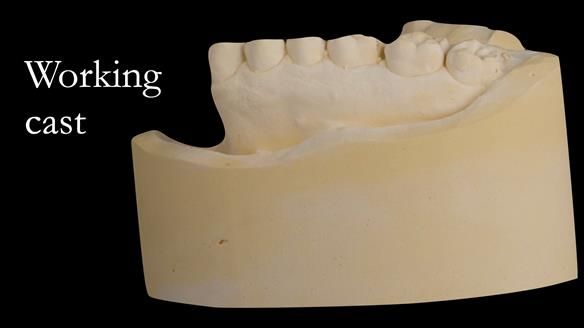 Upper metal base partial denture/occlusal stabilisation splint/obturator - full protocol