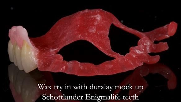 Finlay's Newsletter 64 case study - provision of a Kennedy class 2 metal based Scandinavian RPD for Ian