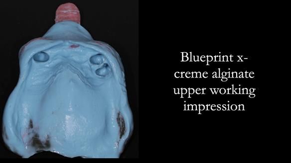 Finlay's Newsletter 59 Ultra hard partial dentures made for Gill