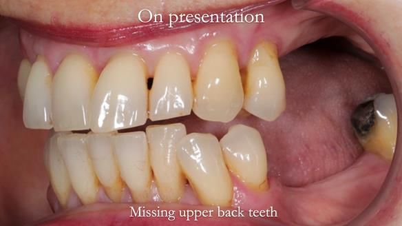 Newsletter 56 showing the making and fitting of a bilateral free end saddle upper removable partial denture (RPD) for patient with pemphigus