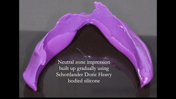 Newsletter 83: Sheila’s Complete Denture Success