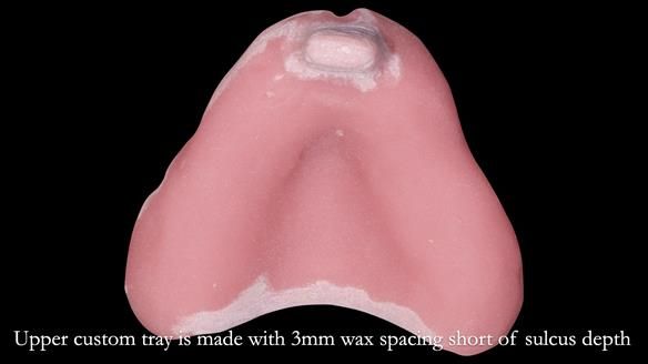 Newsletter 54 case presentation upper complete denture and lower Scandinavian designed hygienic partial denture for David