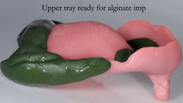 Complete denture Class II div 2 deep overbite Newsletter 39