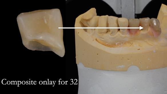 Newsletter 55 Provision of metal based partial dentures for Zephyrine with a repaired cleft lip and palate