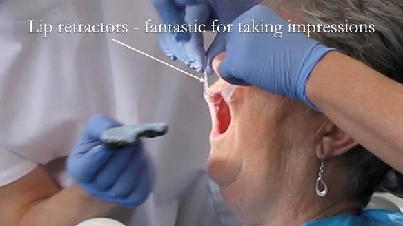 Lip retractors fashioned from photographic retractors are very useful for correct position of the impression tray in the mouth
