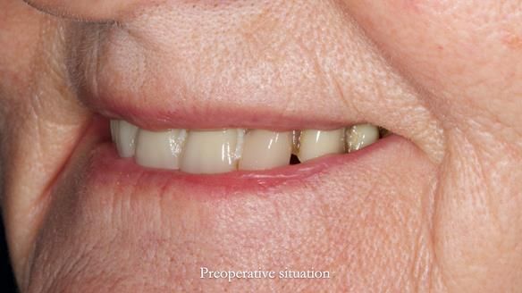 Newsletter 82 Mary - A complete upper and a one-tooth gasket denture
