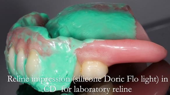 Finlay's Newsletter 62 provision of extractions and metal based complete dentures for Rafique