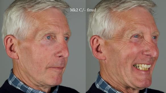 Newsletter 77: Jeremy’s case – immediate complete upper denture