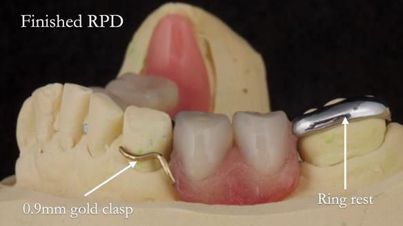 Eileen's transformation with upper and lower RPDs of Scandinavian hygienic design FULL PROTOCOL