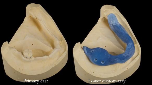 Newsletter 82 Mary - A complete upper and a one-tooth gasket denture