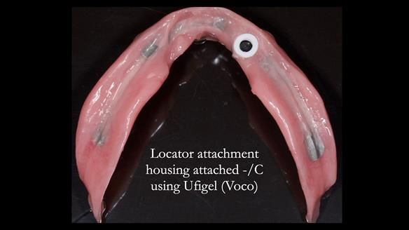 Managing poor implant positioning with complete dentures and Locator attachments - full protocol Newsletter 41