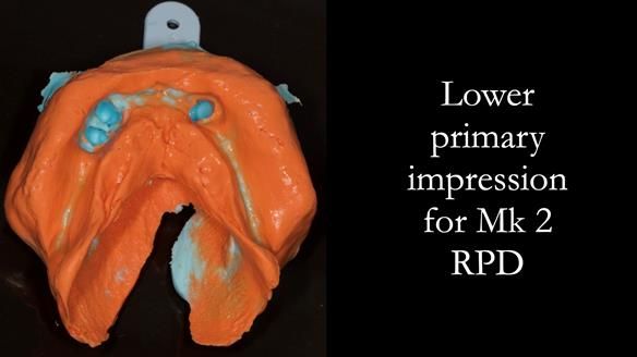 Finlay's Case Study Newsletter 40 - Immediate Mk 1 RPD to Definitive Mk 2 RPD - full protocol