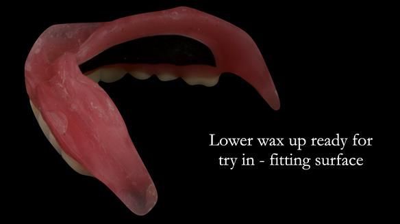 Wax try in ready for visit 4 - notice distinct shape of the denture