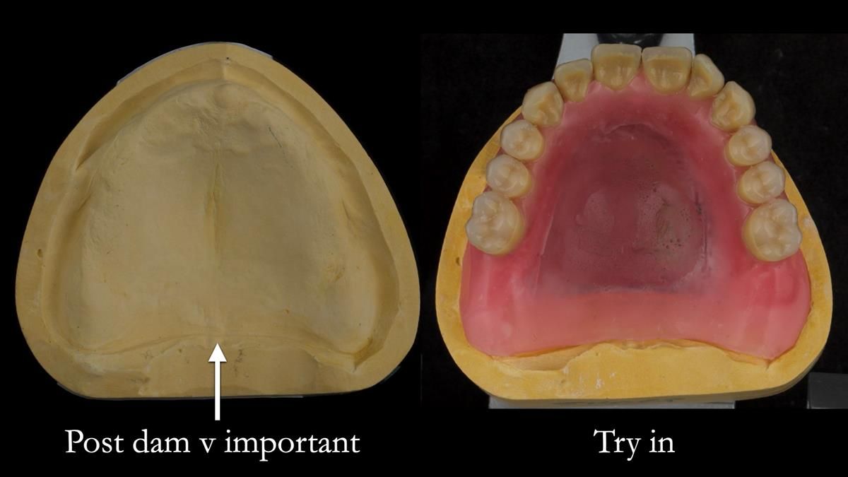 Newsletter 87 – Father Peter: A Partial Denture that needed Minor Miracle