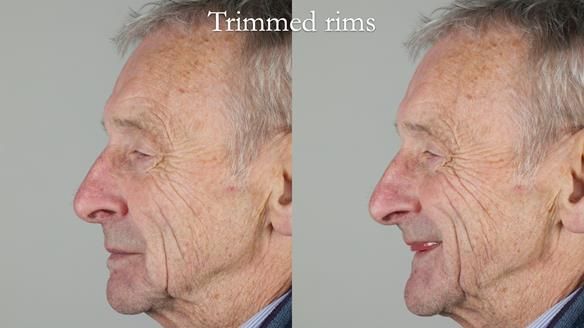 Newsletter 80 - Gordon’s dentures: the one case in 1,000 where my technique failed