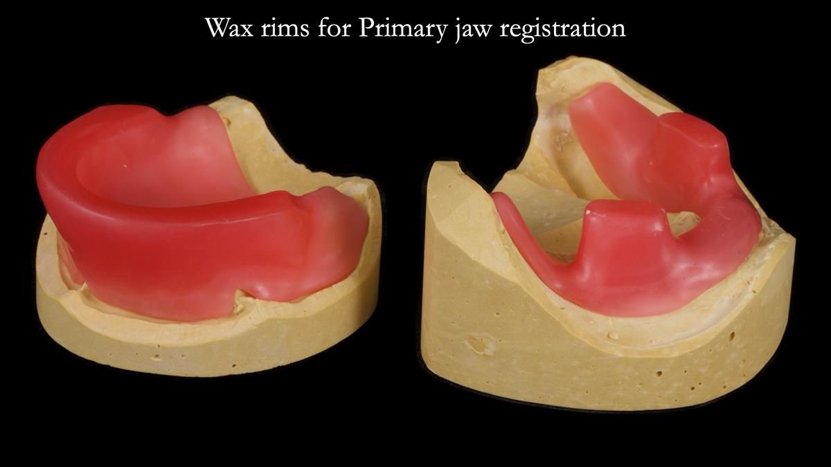 Newsletter 89 – Simon: A Challenging Kennedy Class II Division 1 Upper CoCr Partial Denture with a High Smile Line