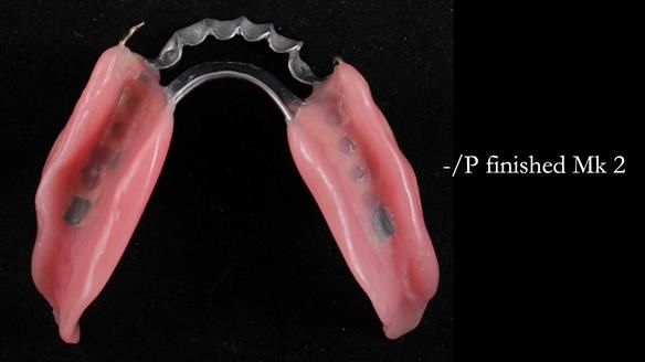 Newsletter 52 Managing Jo’s failing dentition with extractions and Mk 1/Mk 2 complete upper dentures and lower partial dentures FULL PROTOCOL