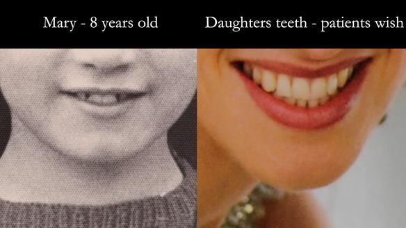 The patient at the age of 8. This enabled calculation of the width of the upper central incisors. 8.5mm. Carol wanted to have teeth similar to her daughter’s beautiful natural dentition.