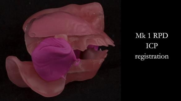 Finlay's Case Study Newsletter 40 - Immediate Mk 1 RPD to Definitive Mk 2 RPD - full protocol