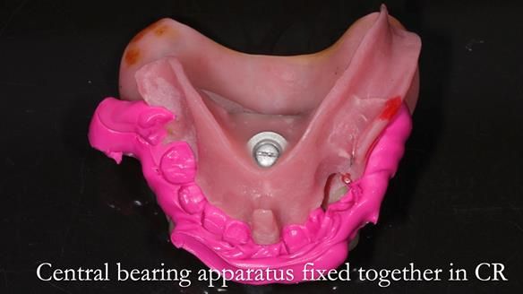 Newsletter 54 case presentation upper complete denture and lower Scandinavian designed hygienic partial denture for David